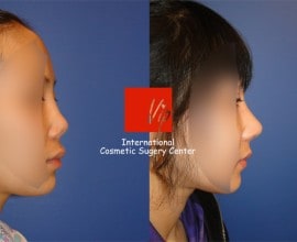 Revision of silicone nose with Rib cartilage