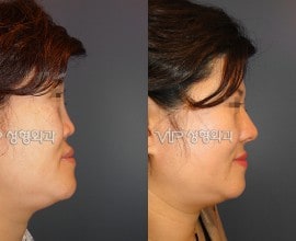 Revision- correction of depressed nose with Rib cartilage