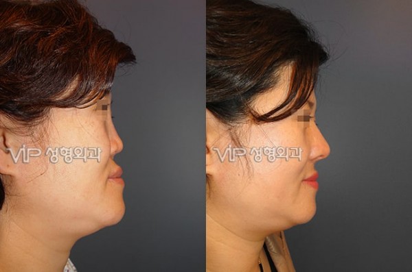 	Harmony-Rhinoplasty, Protruded Mouth Correction Rhinoplasty, Rib cartilage Rhinoplasty	 - Revision- correction of depressed nose with Rib cartilage