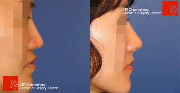 Facial Bone Surgery - VIP High technique rhinoplasty