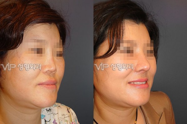 	Harmony-Rhinoplasty, Protruded Mouth Correction Rhinoplasty, Rib cartilage Rhinoplasty	 - Revision- correction of depressed nose with Rib cartilage