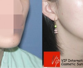 Square jaw reduction surgery