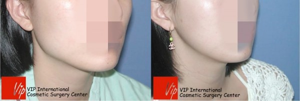 Facial Bone Surgery - Square jaw reduction surgery