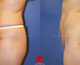 Buttocks augmentation with fat graft