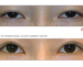 Ptosis correction