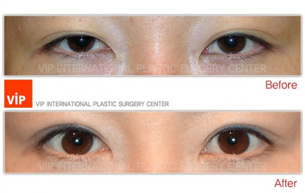 	Eye Surgery, Double Fold, Ptosis Correction	 - Ptosis correction