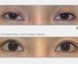 Ptosis correction