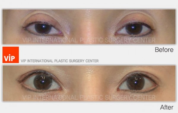 	Eye Surgery, Double Fold, Ptosis Correction	 - Ptosis correction