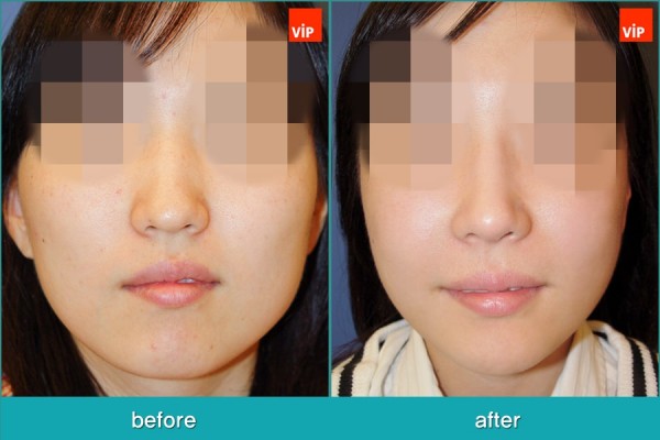 	Nose Surgery, Septal Deviation, Epicanthoplasty	 - Septorhinoplasty, Face Contouring Surgery, Jawline Reduction, Cheekbone Reduction