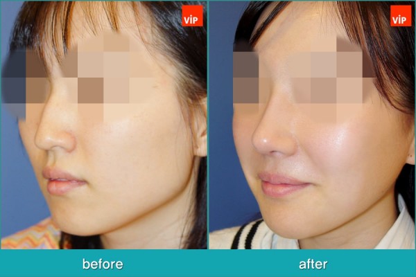	Nose Surgery, Septal Deviation, Epicanthoplasty	 - Septorhinoplasty, Face Contouring Surgery, Jawline Reduction, Cheekbone Reduction