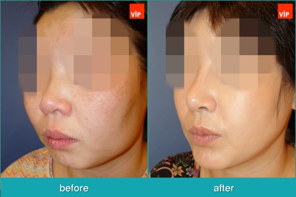 	Nose Surgery, Rib cartilage Rhinoplasty, Facial Bone Surgery, Fat graft	 - Rib Cartilage Rhinoplasty, Face Contouring Surgery, V-line Surgery, Fat Graft, Cheekbone Reduction