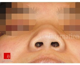 Correction of protruded mouth with Harmony rhinoplasty