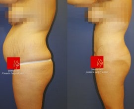 Abdominal surgery with liposuction