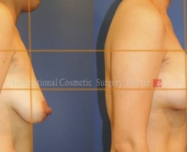 Breast lift & augmentation