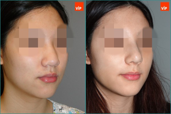 Nose Surgery - Rib cartilage rhinoplasty