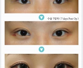 Ptosis Correction