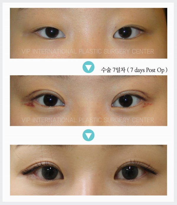 Eye Surgery - Ptosis Correction