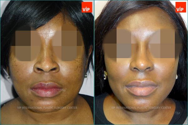 Nose Surgery - Ethnic Rhinoplasty, Septal Deviation Rhinoplasty, Mid-face augmentation