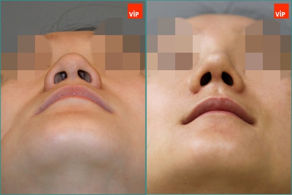 Nose Surgery - Septal cartilage rhinoplasty