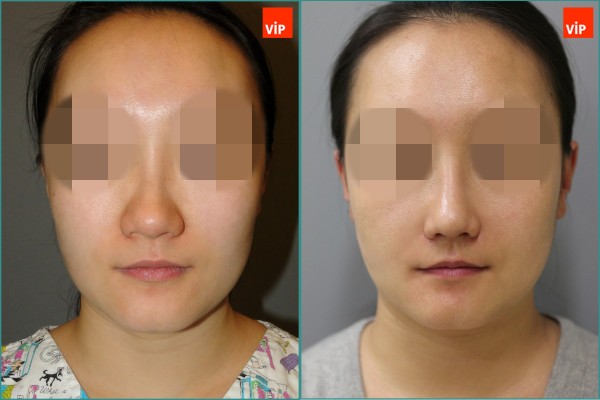 Nose Surgery - Septal cartilage rhinoplasty