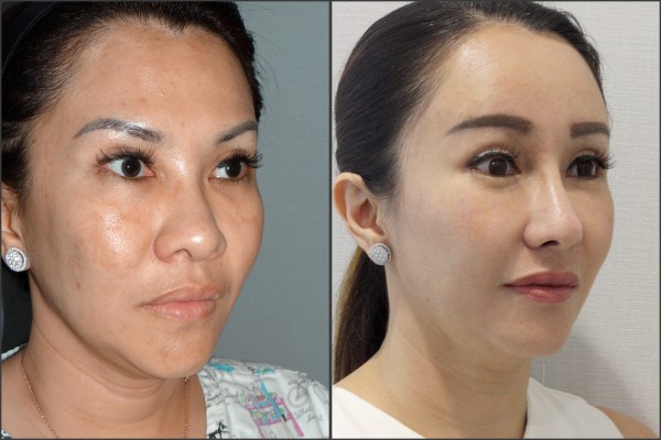 Nose Surgery, Eye Surgery, Face Lift, Fat graft - Rib cartilage Rhinoplasty, Endoscopic Forehead Lift, Fat graft, Lateral Canthoplasty