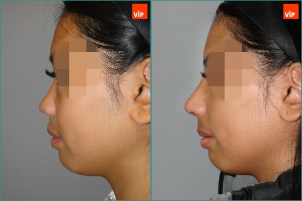 Nose Surgery - Rib cartilage rhinoplasty