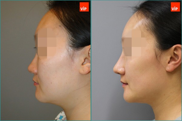 Nose Surgery - Septal cartilage rhinoplasty