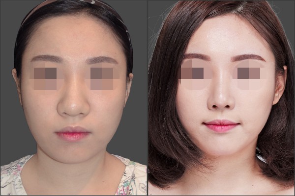 Nose Surgery, Fat graft - Combination Rhinoplasty, Fat graft