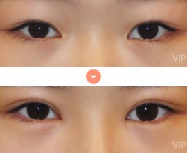 Double Eyelid Surgery