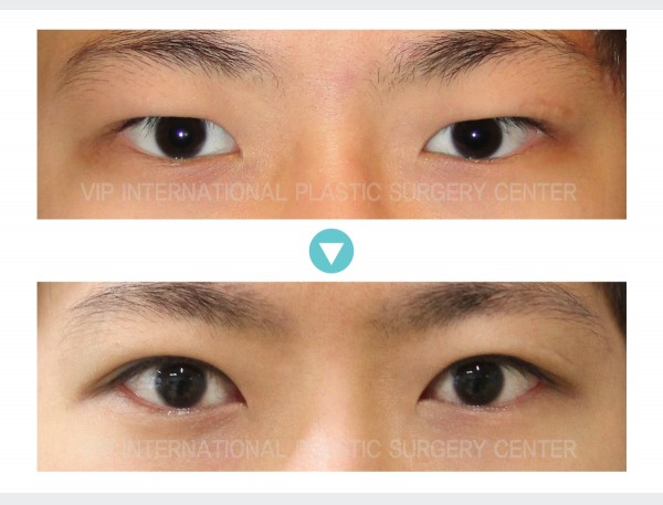 Eye Surgery - Male Ptosis Correction