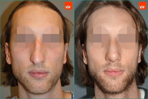 Nose Surgery - Septal cartilage rhinoplasty, Hump Nose