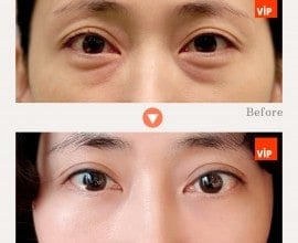 Lower Eyelid Fat Relocation