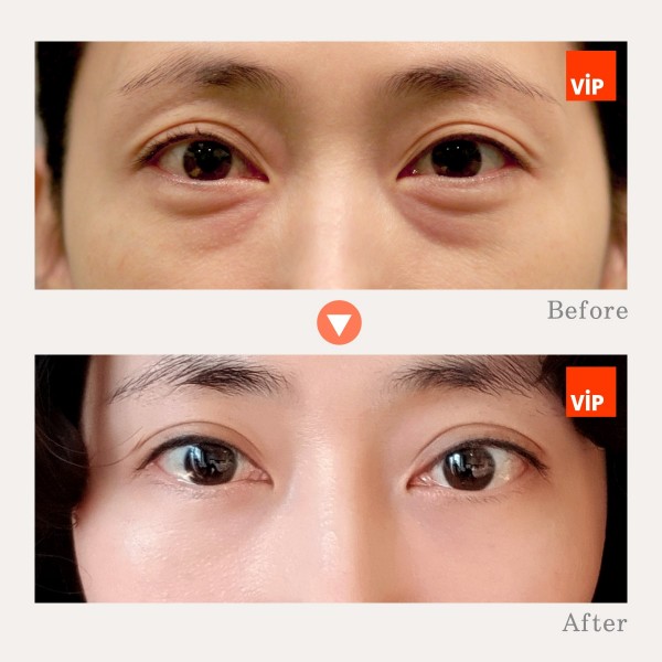 Eye Surgery - Lower Eyelid Fat Relocation