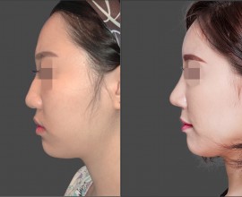 Combination Rhinoplasty, Fat graft