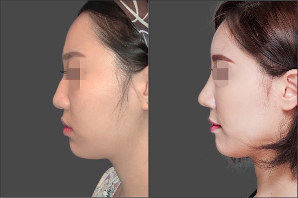 Nose Surgery, Fat graft - Combination Rhinoplasty, Fat graft