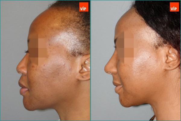 Nose Surgery - Rib cartilage rhinoplasty, Mid face augmentation, Ethnic Rhinoplasty