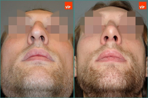 Nose Surgery - Septal cartilage rhinoplasty, Hump Nose