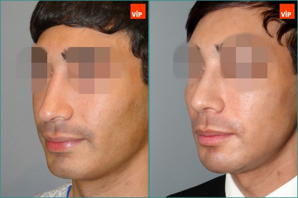 Nose Surgery - Septal cartilage rhinoplasty, Septal Deviation, Long Nose