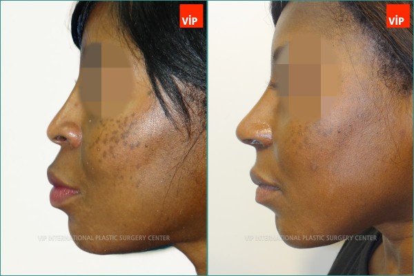 Nose Surgery - Ethnic Rhinoplasty, Septal Deviation Rhinoplasty, Mid-face augmentation