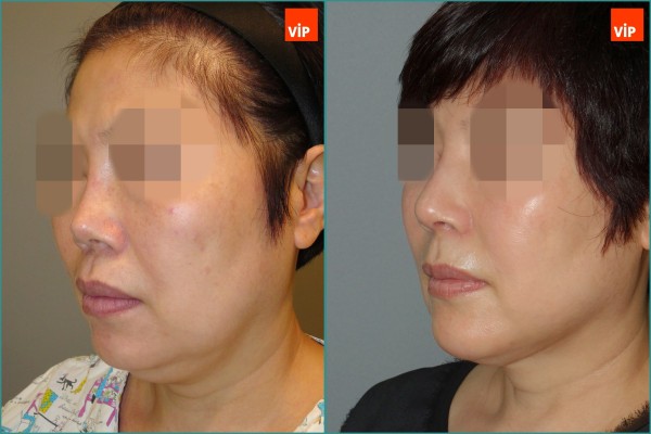 Nose Surgery, Face Lift - Rib Cartilage Rhinoplasty, Facelift