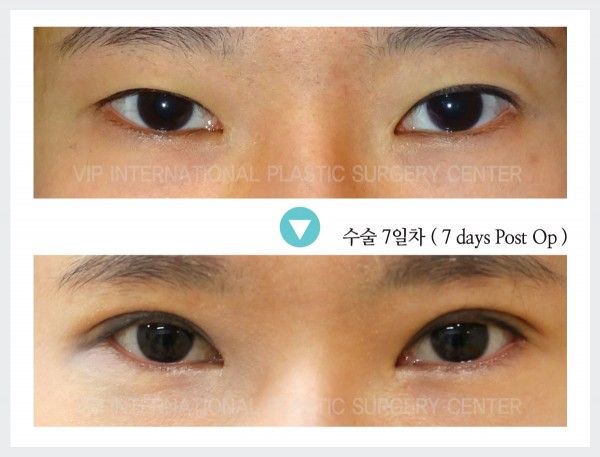 Eye Surgery - Eyelid surgery