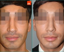 Septal cartilage rhinoplasty, Septal Deviation, Long Nose