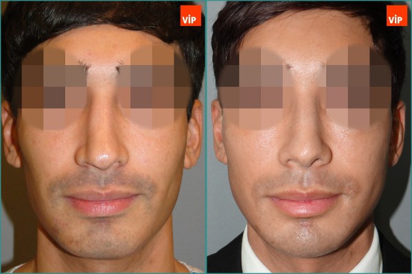 Nose Surgery - Septal cartilage rhinoplasty, Septal Deviation, Long Nose