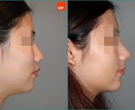 Rib cartilage rhinoplasty