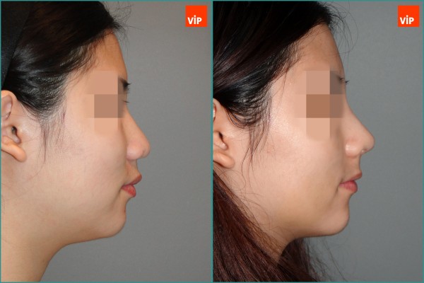 Nose Surgery - Rib cartilage rhinoplasty