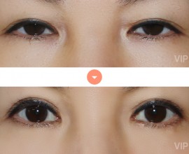 Double eyelid surgery