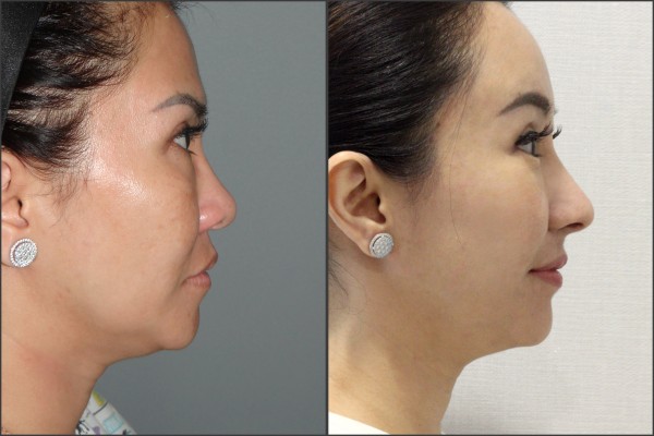 Nose Surgery, Eye Surgery, Face Lift, Fat graft - Rib cartilage Rhinoplasty, Endoscopic Forehead Lift, Fat graft, Lateral Canthoplasty