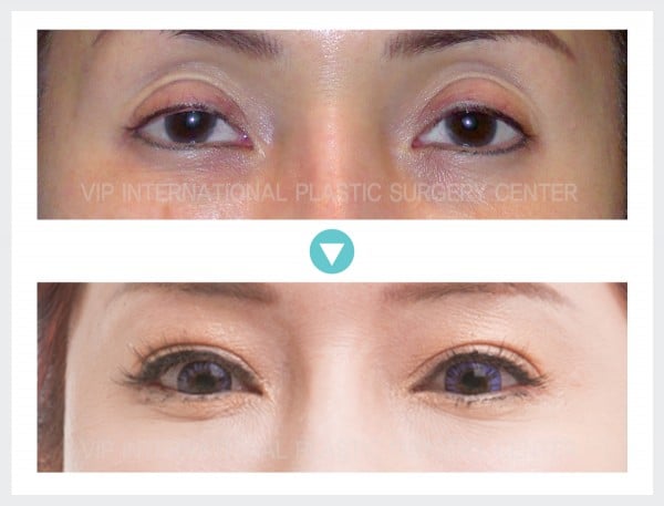 Eye Surgery, Fat graft - Ptosis Correction, Upper Eyelid Fat graft