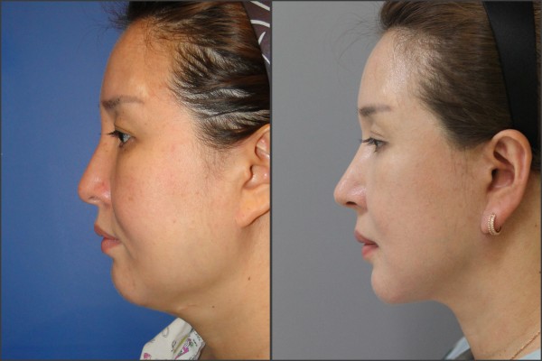 Nose Surgery, Eye Surgery, Face Lift - Facelift, Combination Rhinoplasty, Eyelid Surgery