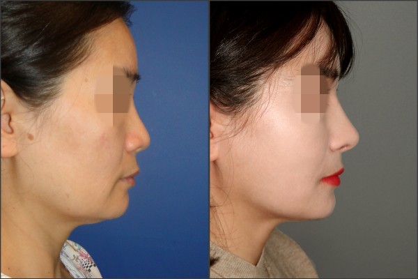 Nose Surgery - Rib cartilage rhinoplasty